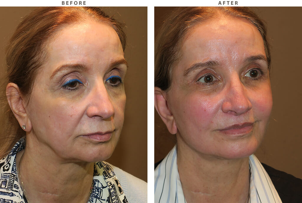 Midface lift Chicago - Before and After Pictures