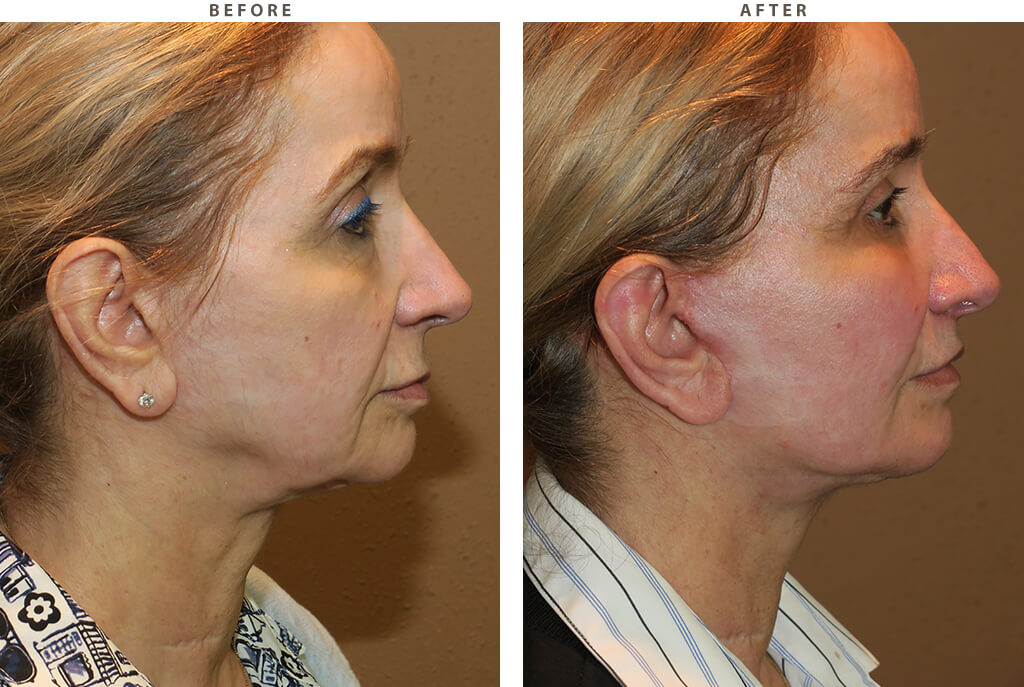 Midface lift Chicago - Before and After Pictures