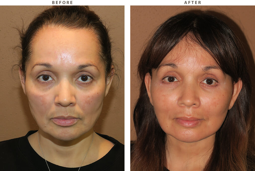 Midface lift Chicago - Before and After Pictures