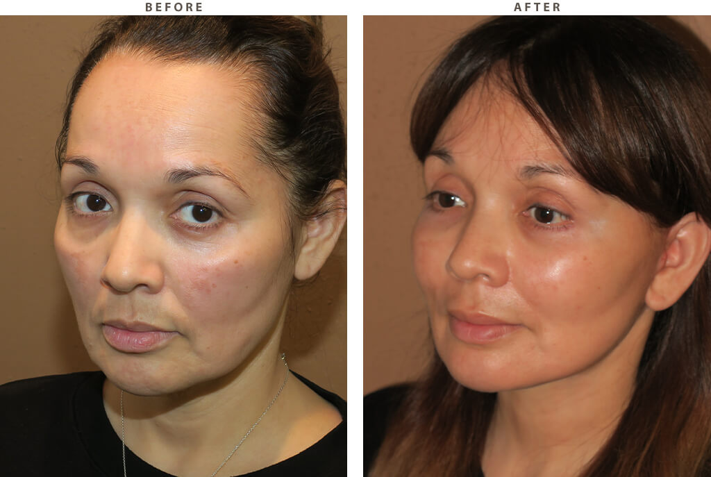Midface lift Chicago - Before and After Pictures