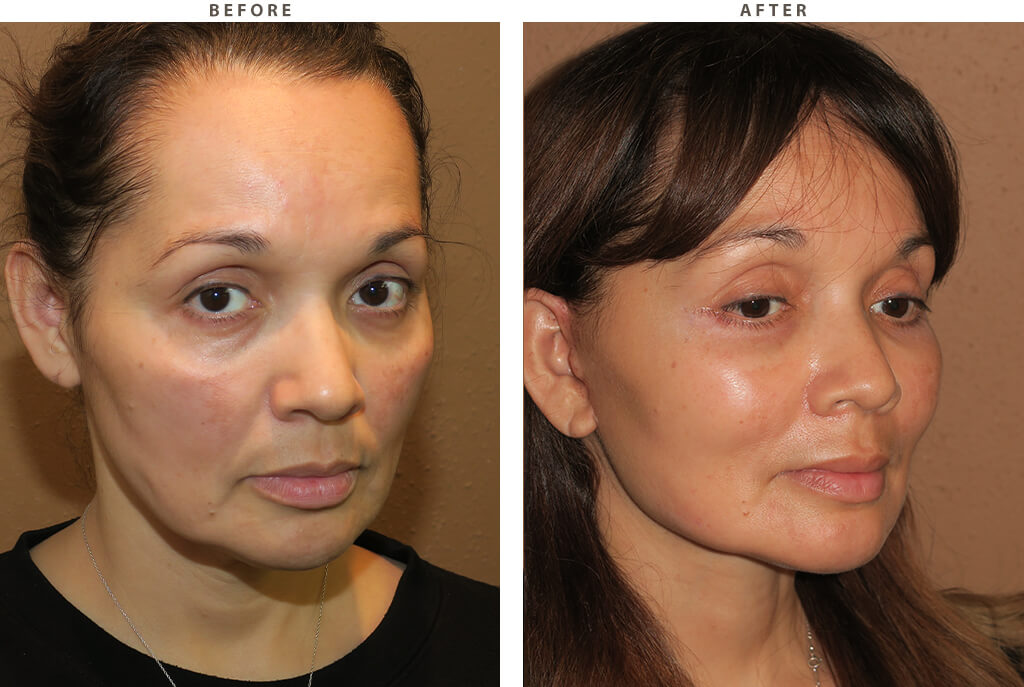 Midface lift Chicago - Before and After Pictures