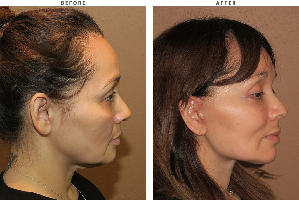 Midface lift Chicago - Before and After Pictures