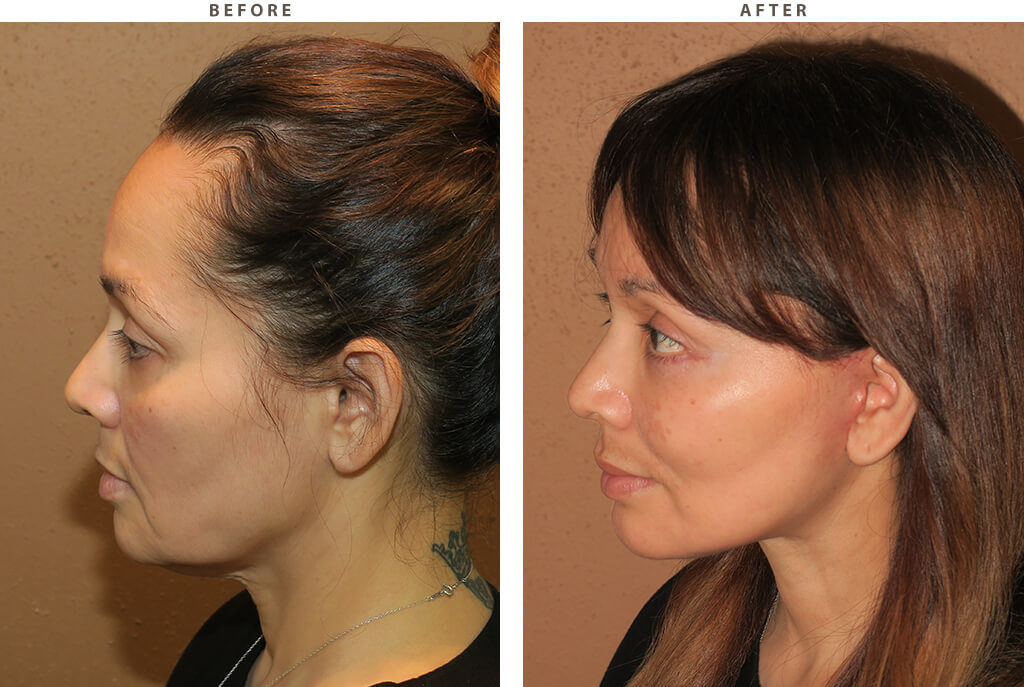 Midface lift Chicago - Before and After Pictures