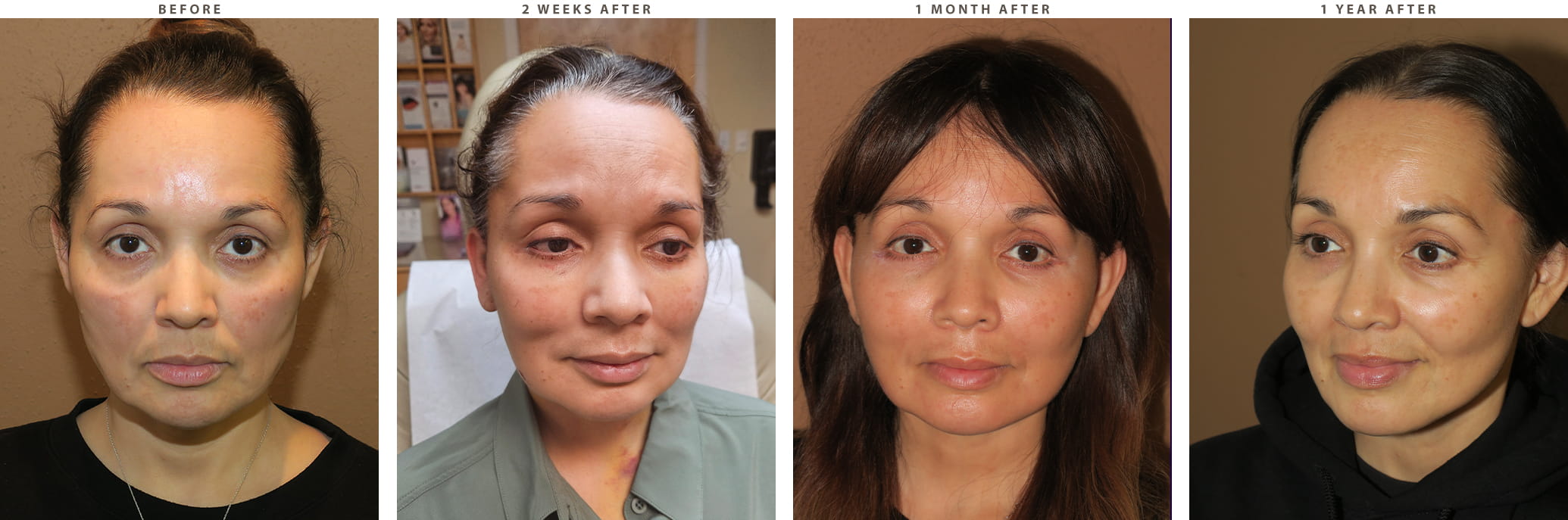 Midface lift Chicago - Before and After Pictures
