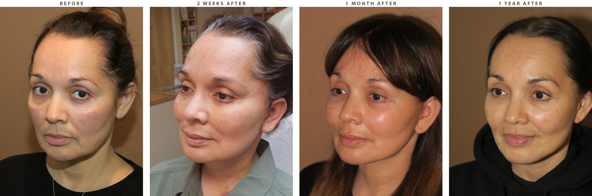 Midface lift Chicago - Before and After Pictures