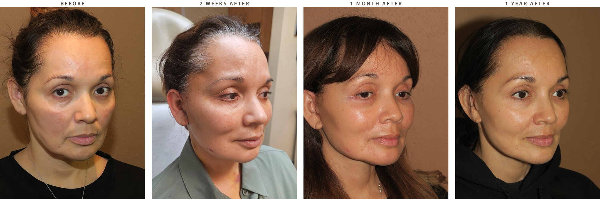 Midface lift Chicago - Before and After Pictures