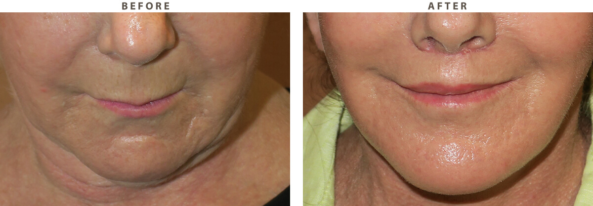 Lip lift Chicago - Before and After Pictures