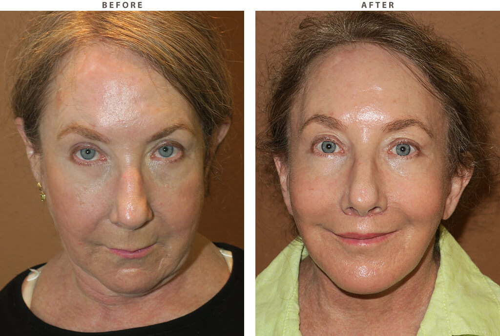 Midface lift Chicago - Before and After Pictures