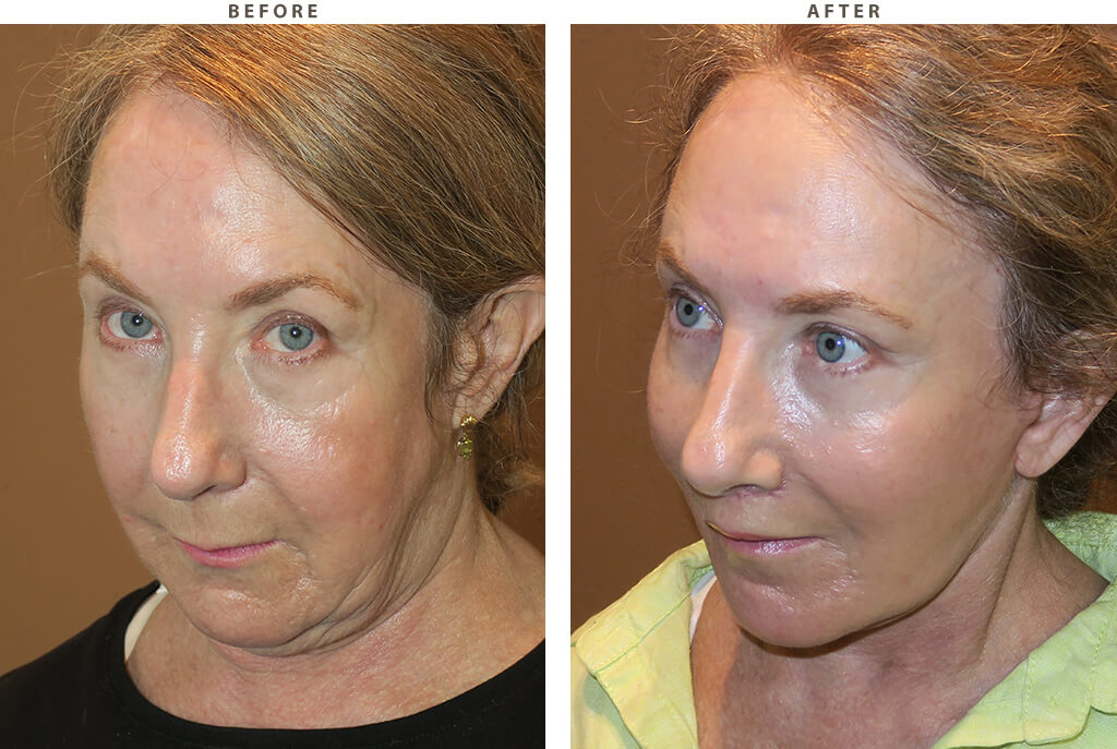 Midface lift Chicago - Before and After Pictures