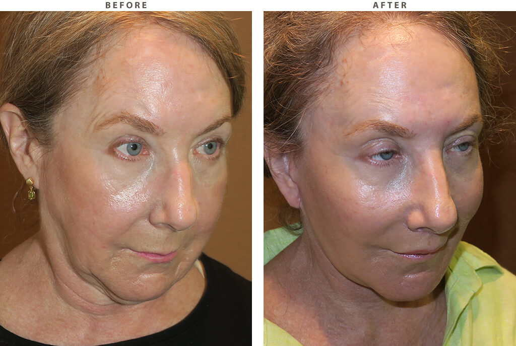 Midface lift Chicago - Before and After Pictures