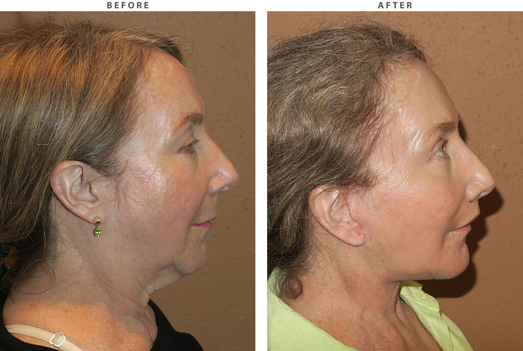 Midface lift Chicago - Before and After Pictures