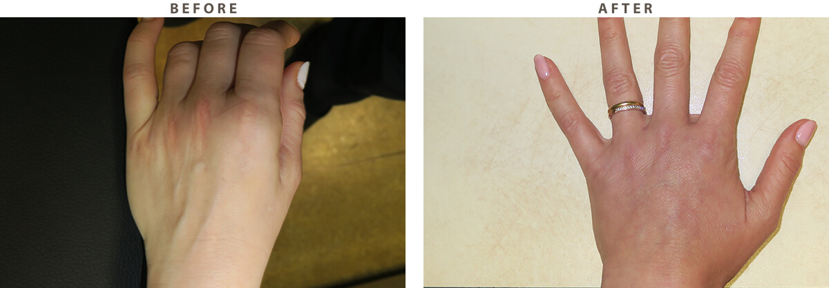 Hand Rejuvenation Chicago - Before and After Pictures