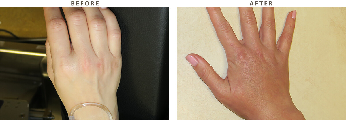 Hand Rejuvenation Chicago - Before and After Pictures