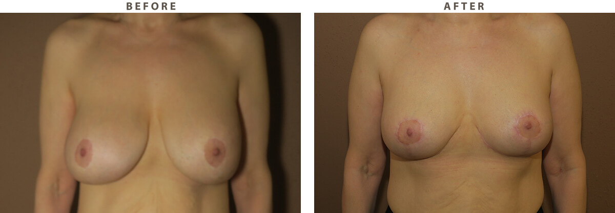 Breast lift Chicago - Before and After Pictures