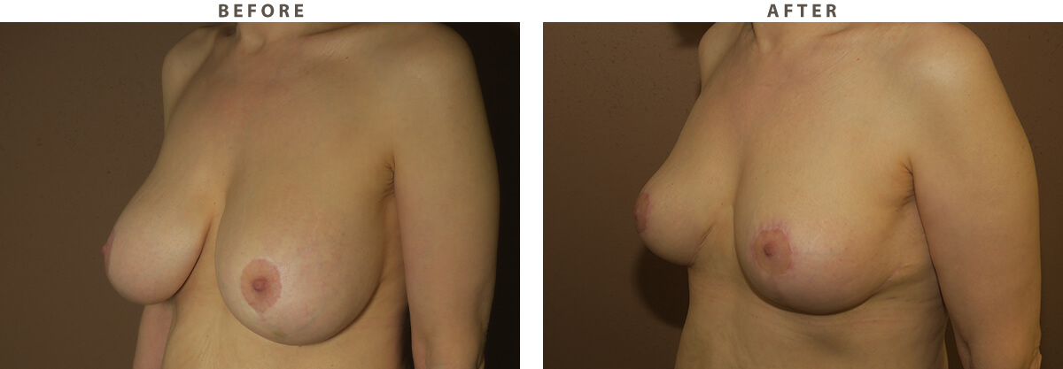 Breast lift Chicago - Before and After Pictures