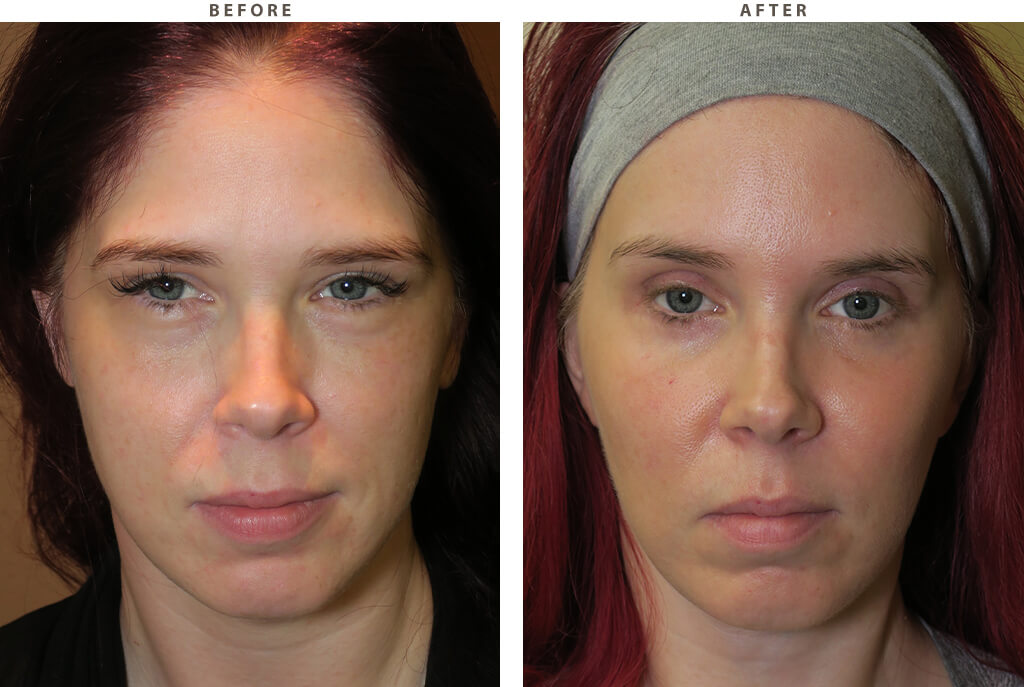 Malar cheek implants Chicago - Before and After Pictures