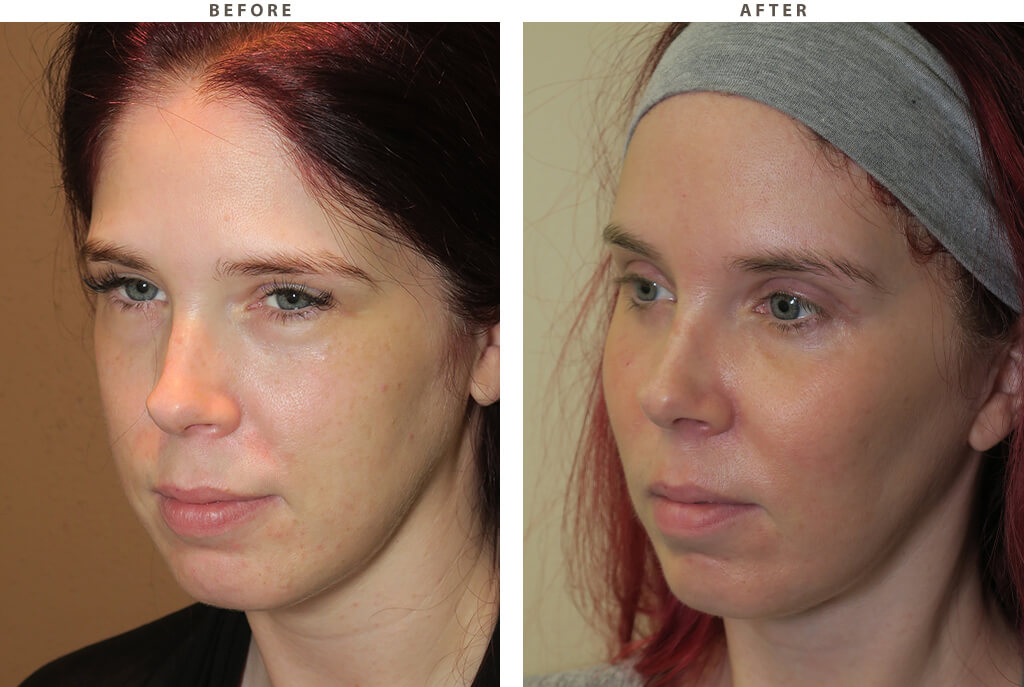 Malar cheek implants Chicago - Before and After Pictures