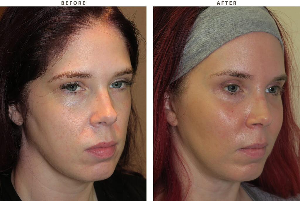Malar cheek implants Chicago - Before and After Pictures