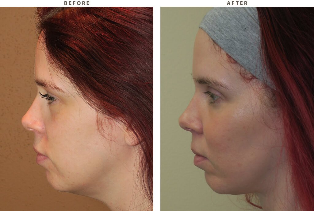 Malar cheek implants Chicago - Before and After Pictures