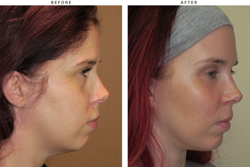 Malar cheek implants Chicago - Before and After Pictures
