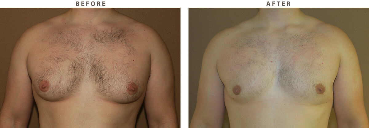 Gynecomastia- Before and After Pictures