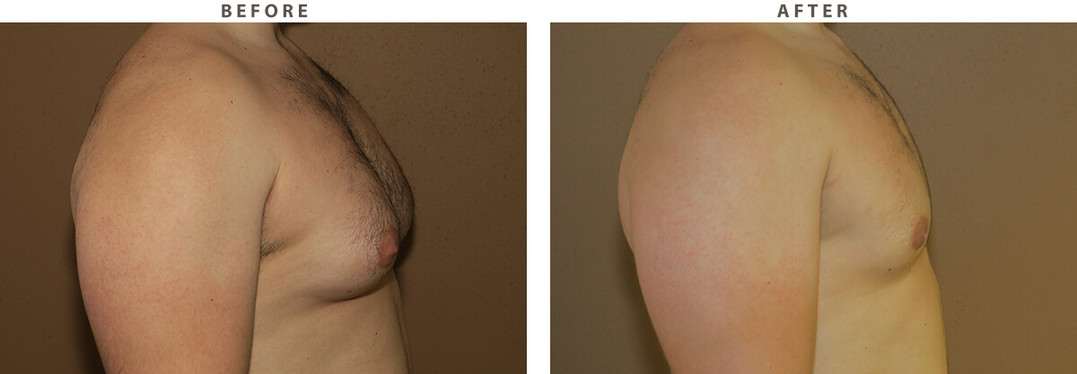 Gynecomastia- Before and After Pictures