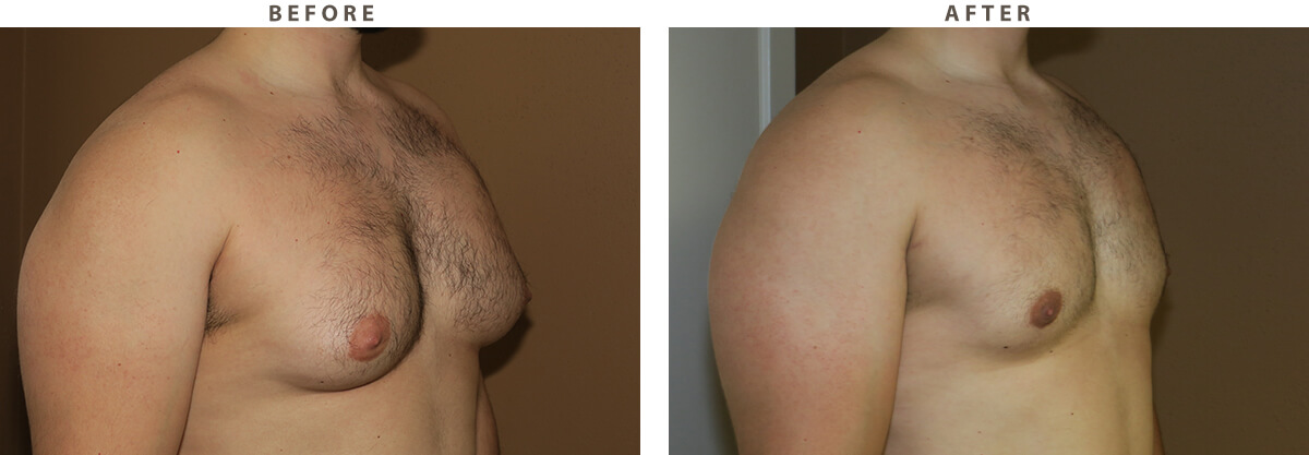 Gynecomastia- Before and After Pictures