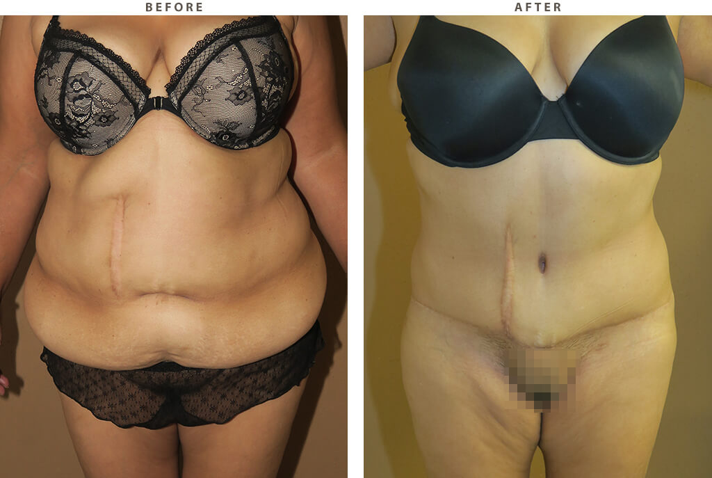 Body Lift - Before and After Pictures