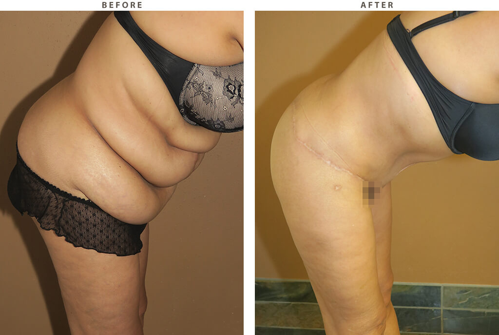 Body Lift - Before and After Pictures