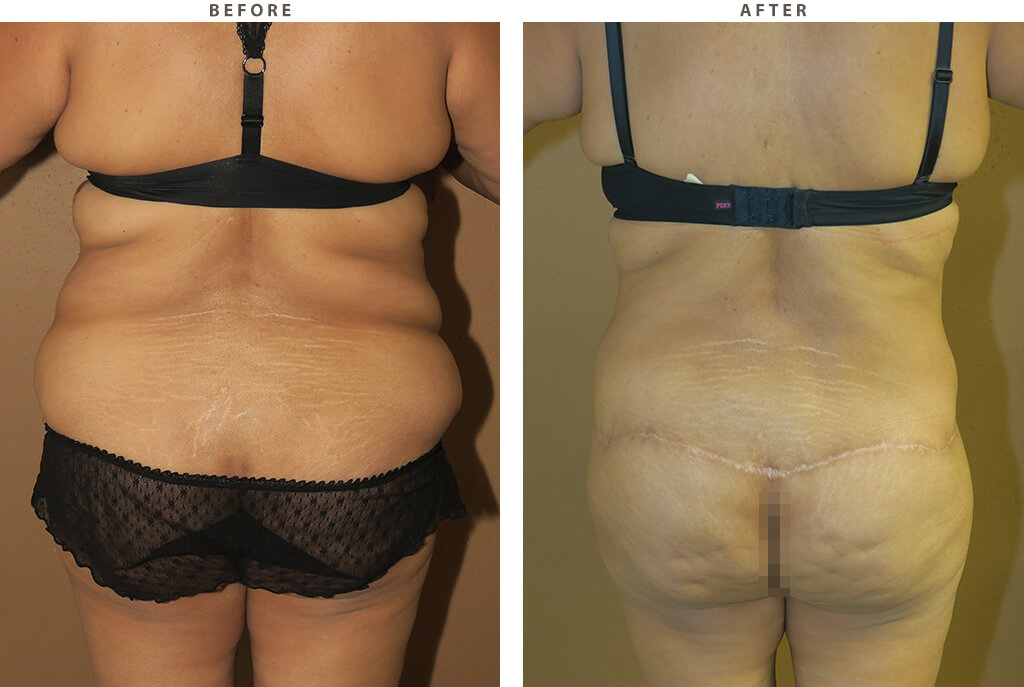 Body Lift - Before and After Pictures