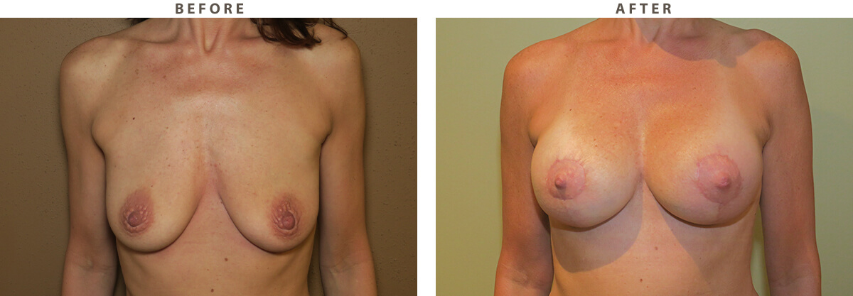 Breast lift Chicago - Before and After Pictures