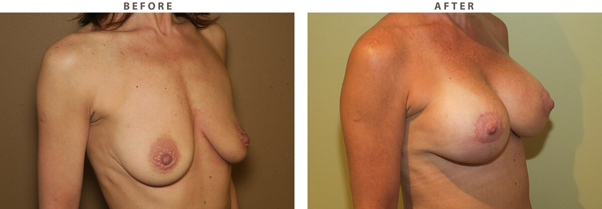 Breast lift Chicago - Before and After Pictures