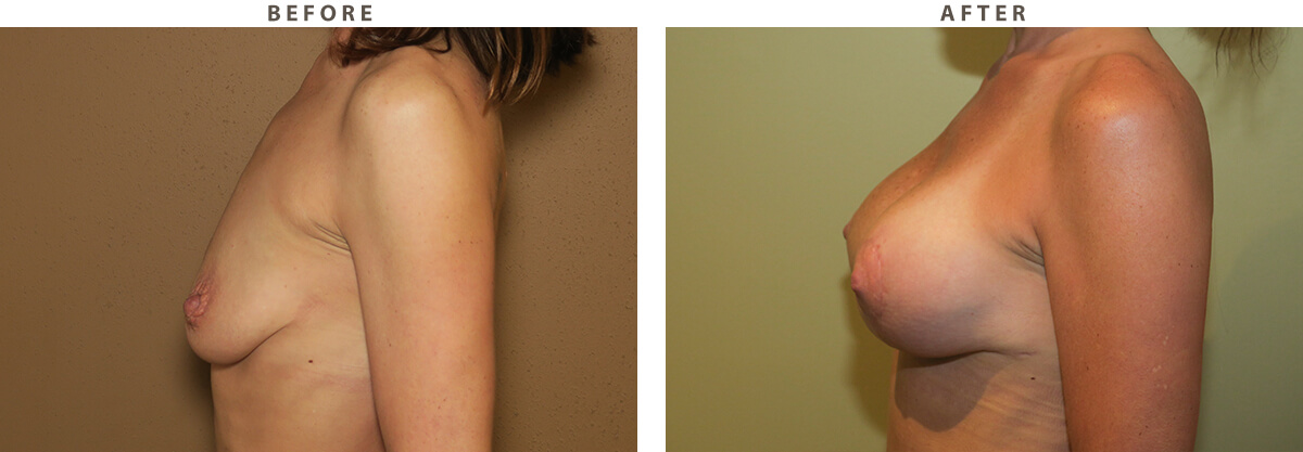 Breast lift Chicago - Before and After Pictures