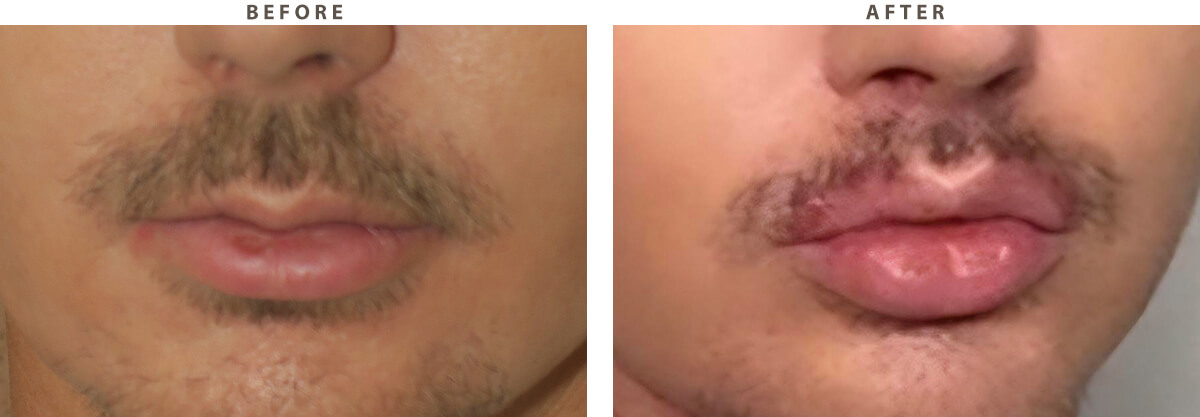 Lip lift Chicago - Before and After Pictures