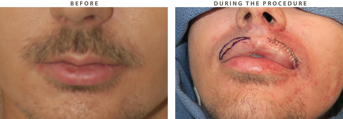 Lip lift Chicago - Before and After Pictures