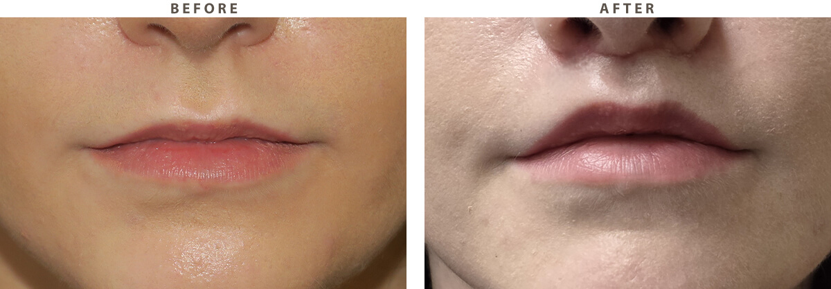 Lip lift Chicago - Before and After Pictures