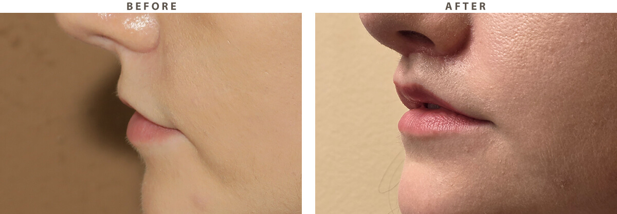 Lip lift Chicago - Before and After Pictures