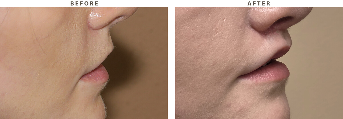 Lip lift Chicago - Before and After Pictures
