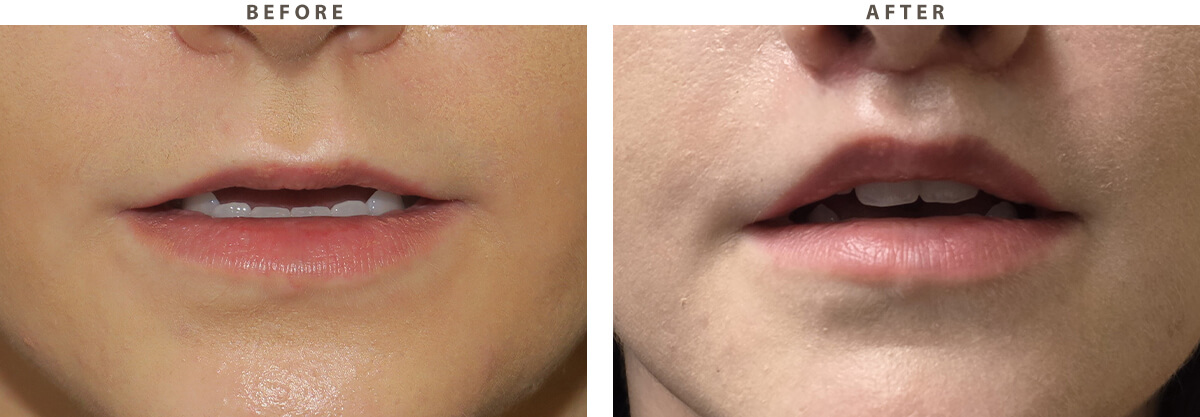 Lip lift Chicago - Before and After Pictures
