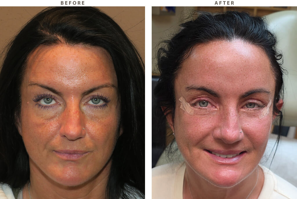 Blepharoplasty Chicago - Before and After Pictures