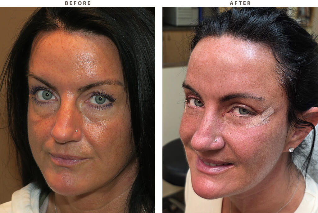 Blepharoplasty Chicago - Before and After Pictures