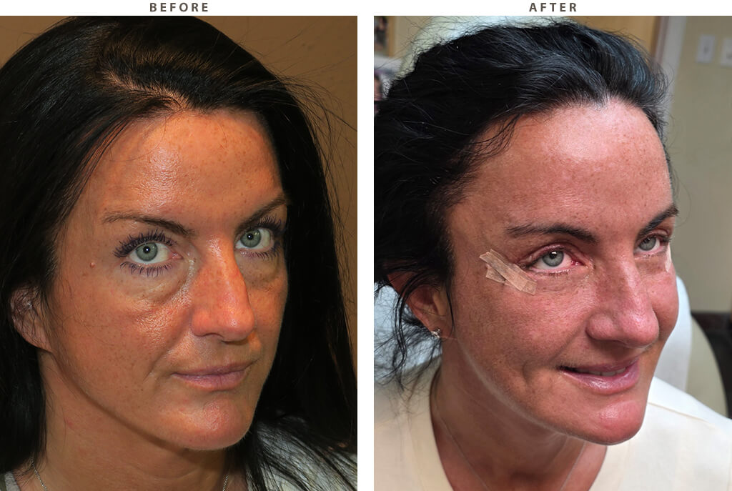 Blepharoplasty Chicago - Before and After Pictures