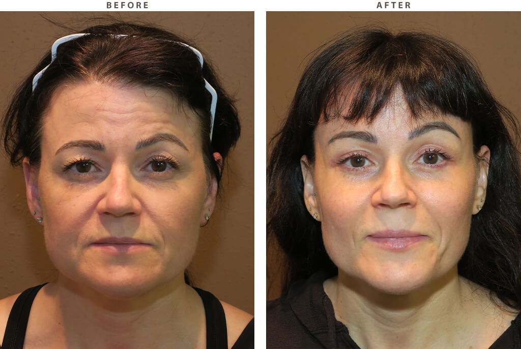 Mid facelift Chicago - Before and After Pictures