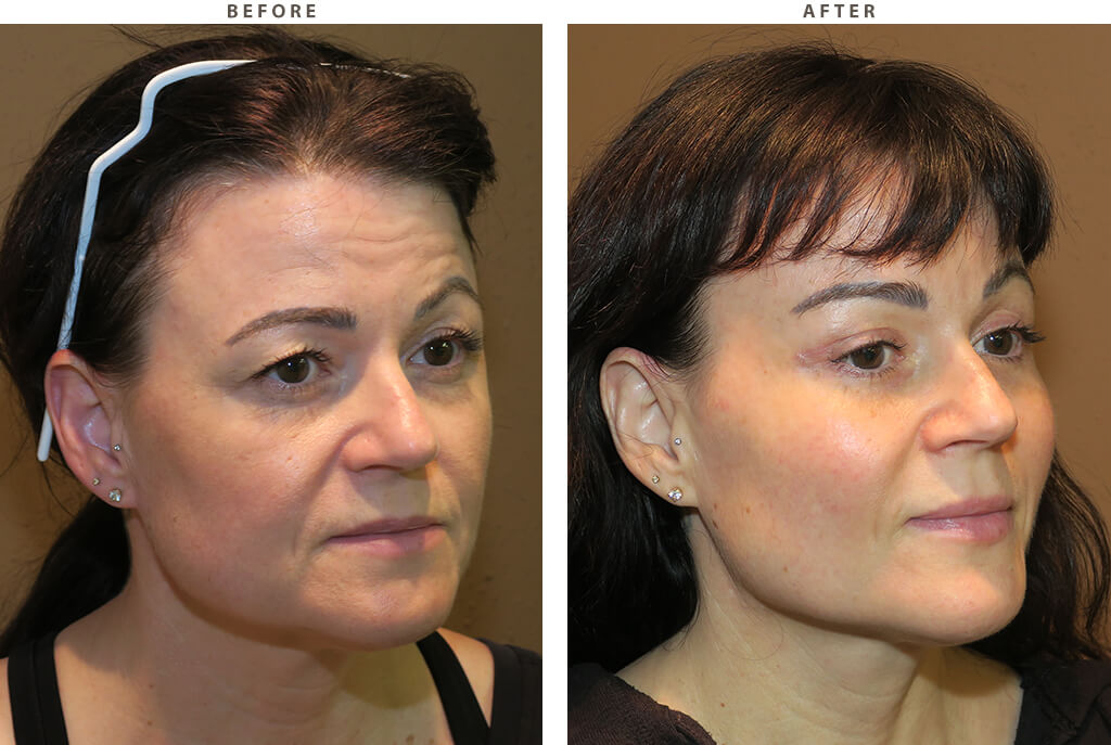 Mid facelift Chicago - Before and After Pictures