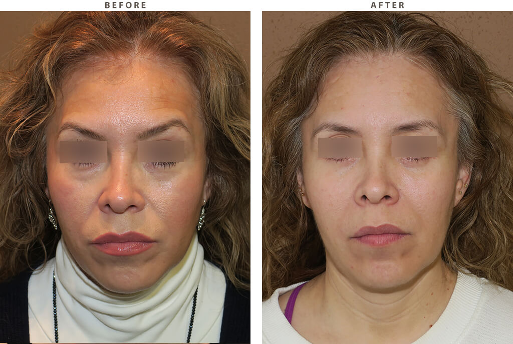 Mid facelift Chicago - Before and After Pictures