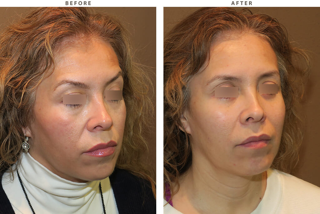 Mid facelift Chicago - Before and After Pictures