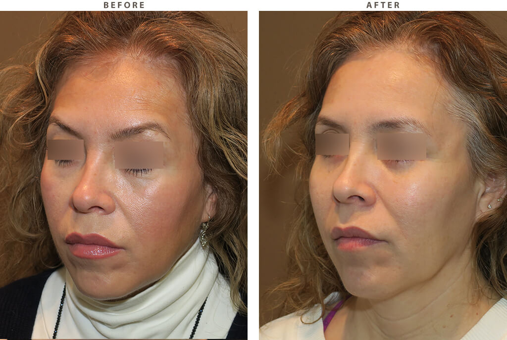 Mid facelift Chicago - Before and After Pictures