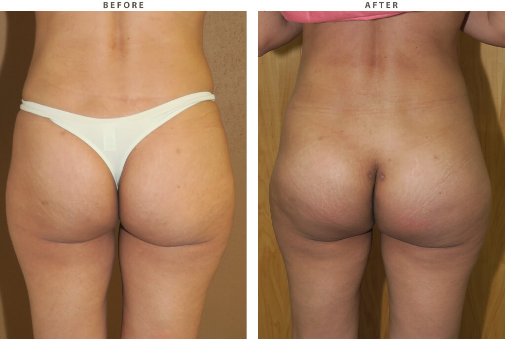 Buttock augmentation Chicago - Before and After Pictures