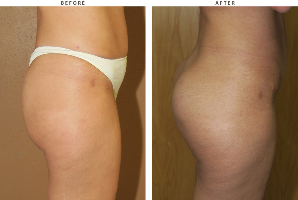 Buttock augmentation Chicago - Before and After Pictures