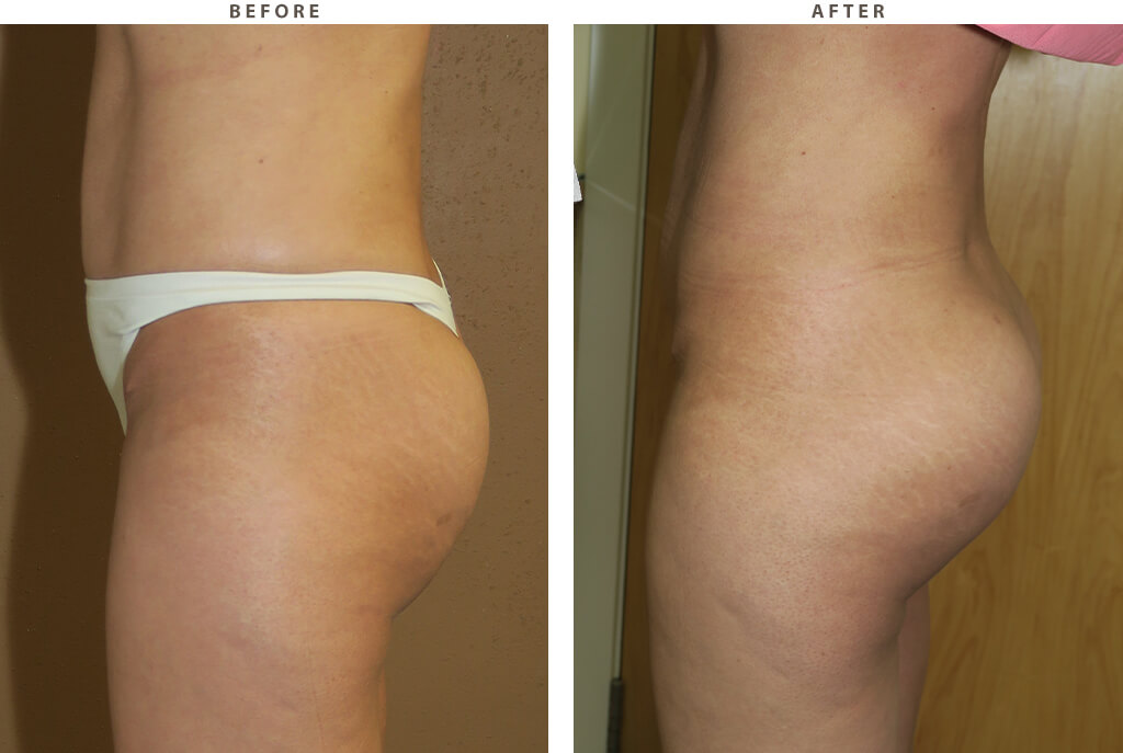 Buttock augmentation Chicago - Before and After Pictures